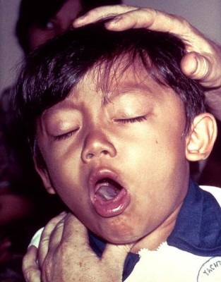 A young boy coughing due to pertussis. Source: CDC.